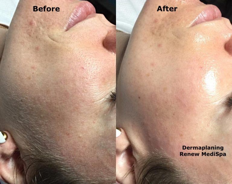 Dermaplaning is a safe and effective exfoliation method for removing dead skin and vellus hair (peach fuzz) from the surface of the skin. Can be done as an add on to a facial, or the full service also includes a light chemical peel.