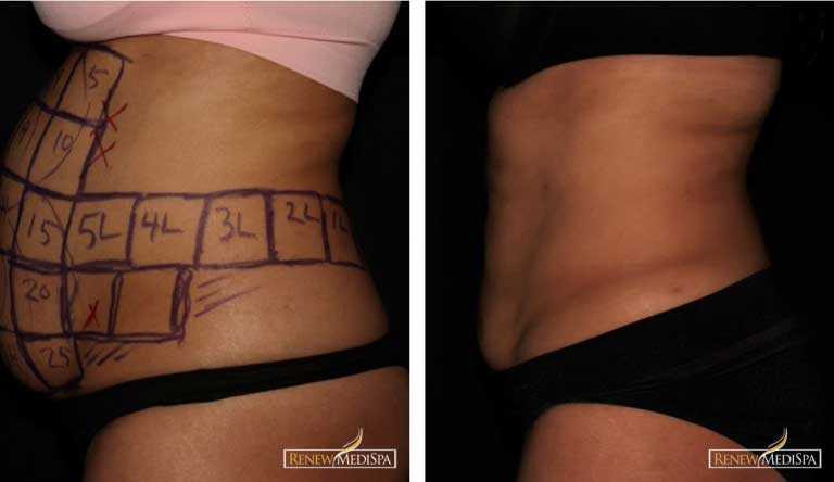 Bodysculpting at Renew MediSpa