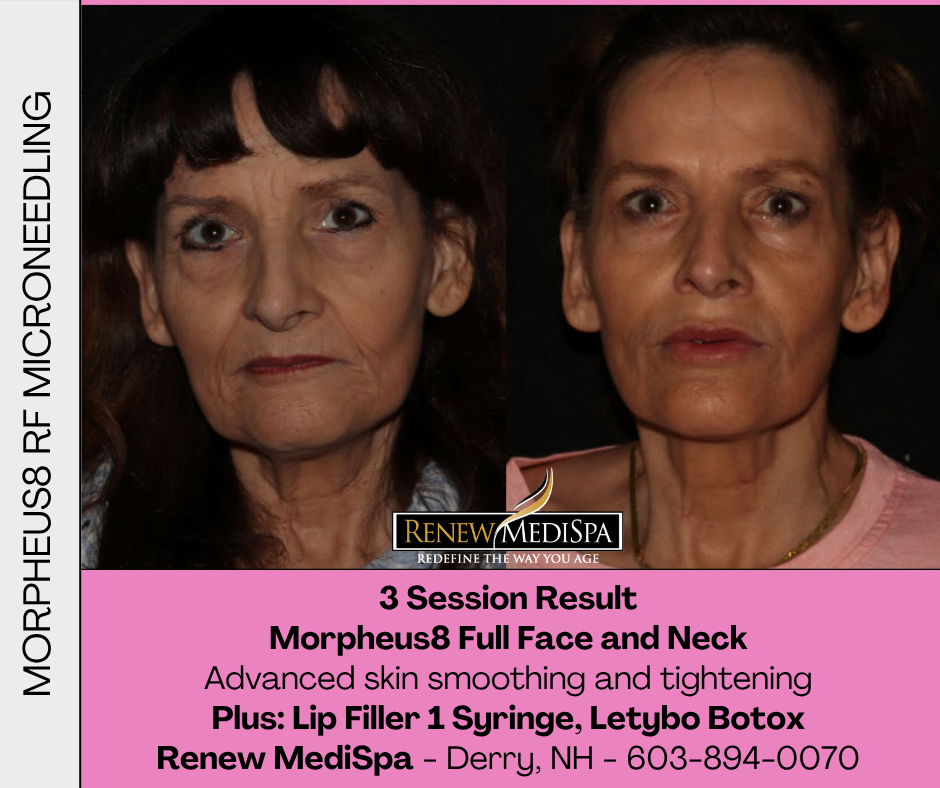 Before-and-after photos of a woman following three Morpheus8 RF microneedling treatments to the full face and neck, combined with one syringe of lip filler and Letybo botulinum toxin at Renew MediSpa in Derry, NH. The after image shows smoother, firmer-looking skin and improved facial contours.
