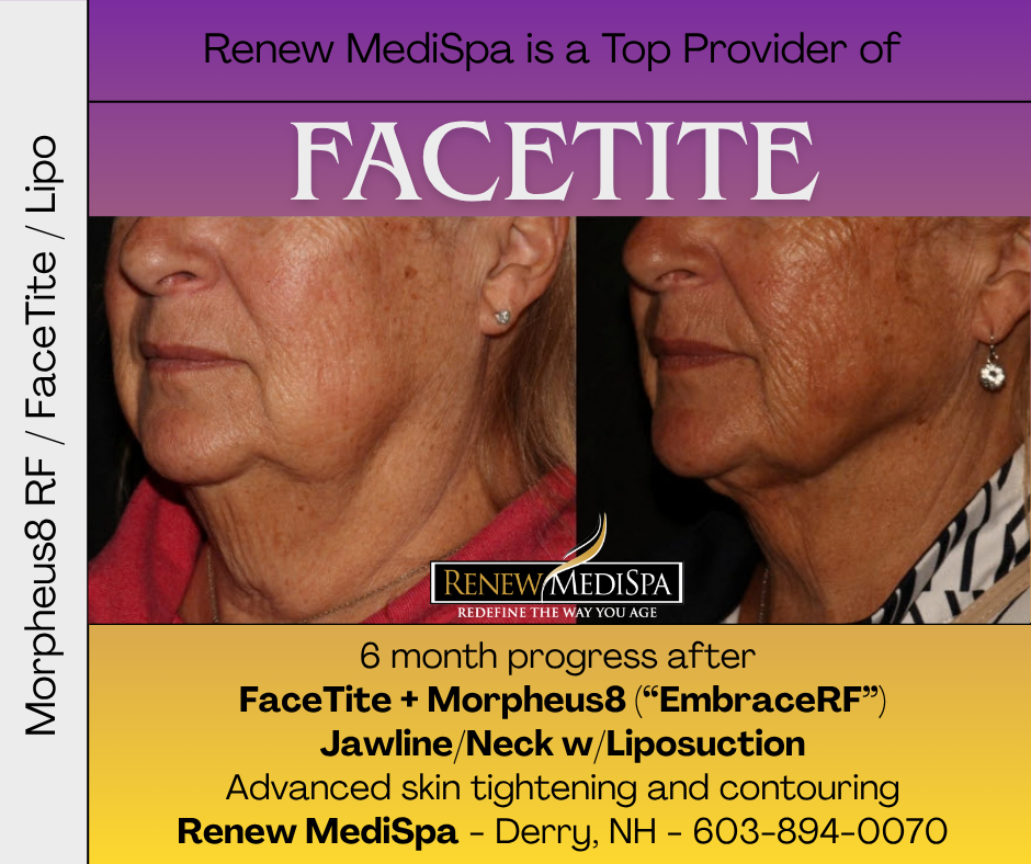 Before and after FaceTite, Morpheus8 RF microneedling and liposuction for jawline and neck tightening at Renew MediSpa in Derry, NH.