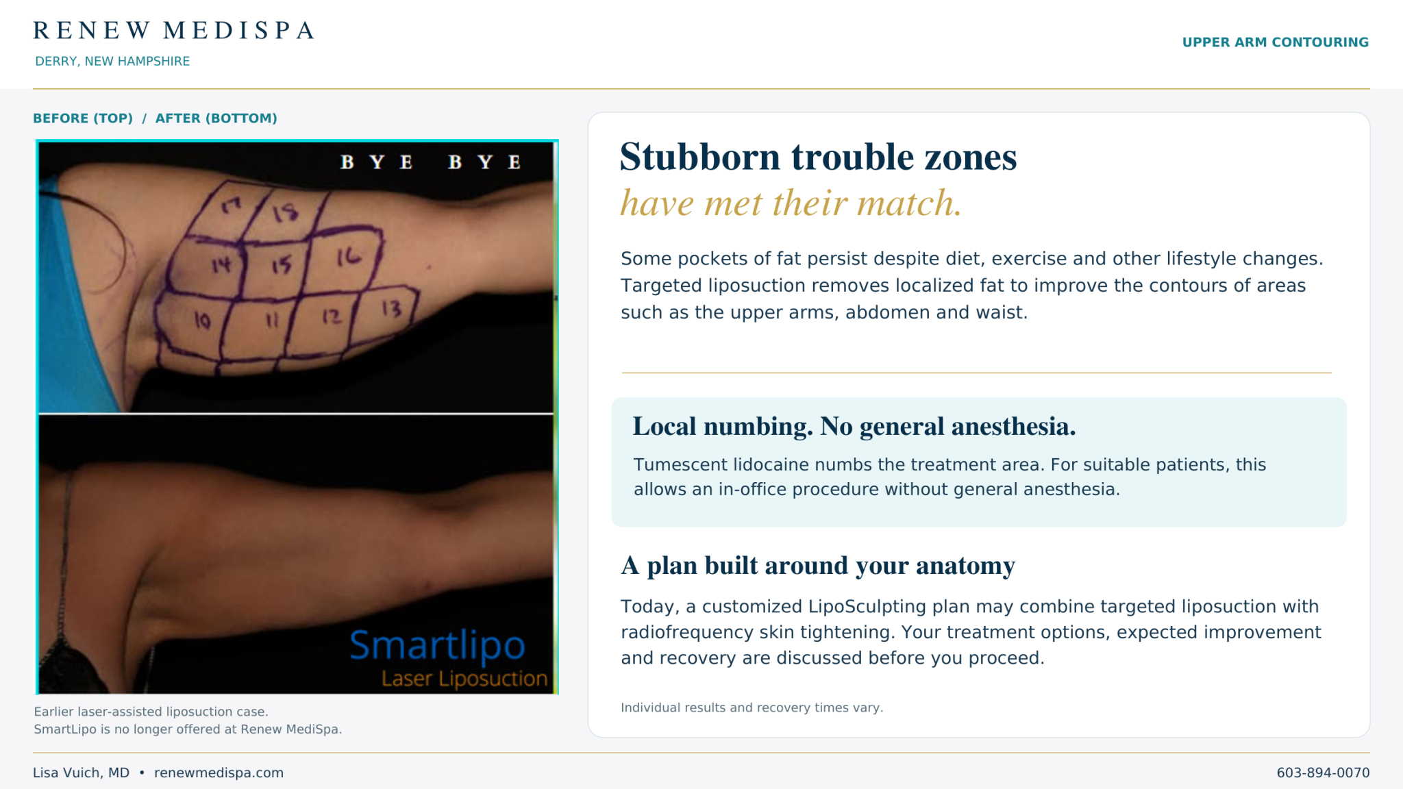 Upper-arm photos before treatment with planning marks and after laser-assisted liposuction, beside information about local anesthesia and contouring.